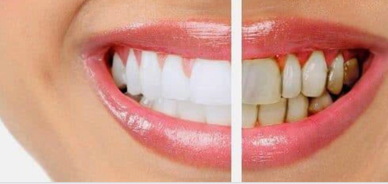 Periodontoloji (Diş Eti Hastalıkları)