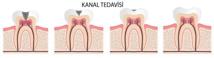 Kanal Tedavisi